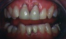 Gum Recession Above Crowns