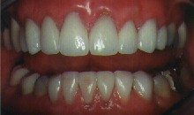 After Cosmetic Dentistry