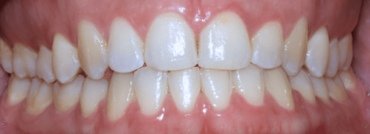 Showing the smile after Invisalign at Dental Care Stamford